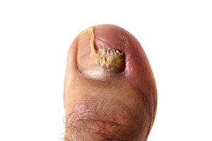 Crumbling Toenails Can Signal a Fungal Infection