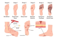 Stages of Diabetic Foot Ulcers