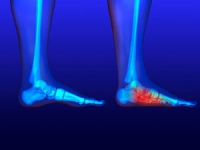 Reasons Flat Feet Occur