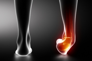 Treatment for Broken Ankles