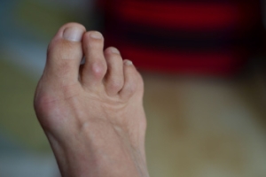 Facts About Hammertoe