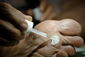 Treatment for Plantar Warts