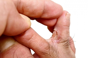 Recognizing Athlete’s Foot