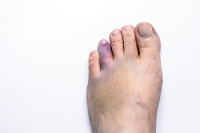 Various Categories of Broken Toes