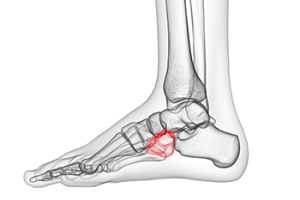 How Does the Cuboid Bone Become Displaced?