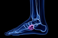 A Closer Look at Causes of Cuboid Syndrome