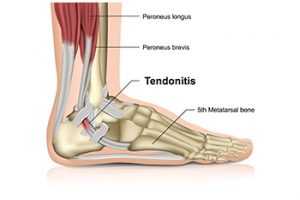 Minimally Invasive Achilles Tendon Surgery