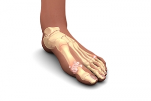Prevention Tips for Gout