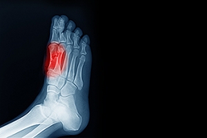 Who Is Prone to Developing Sesamoiditis?