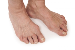 Rheumatoid Arthritis