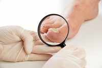 Causes and Symptoms of Toenail Fungus