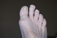 Effects of Morton’s Toe