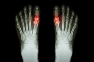 Understanding Common Causes of Gout