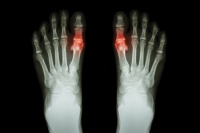 Understanding Common Causes of Gout