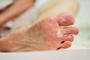 Can Children Get Plantar Warts?