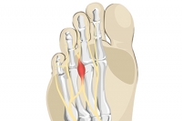 The Discomfort of Morton’s Neuroma