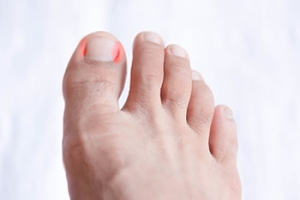 Relieving Ingrown Toenail Pain With Simple Treatments