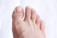 Relieving Ingrown Toenail Pain With Simple Treatments