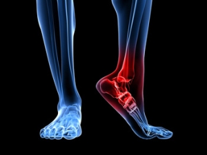 Sever&#039;s Disease Causes Heel Pain in Children