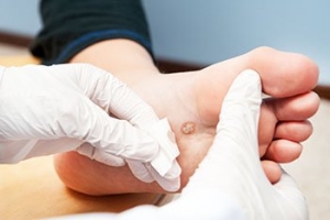 How Can I Treat My Plantar Wart?