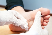 How Can I Treat My Plantar Wart?